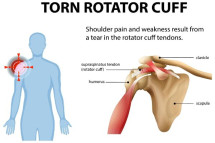Rotator Cuff Repair Recovery: First 3 Months After Surgery