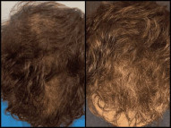 Hair Loss Solutions Dallas | Women’s Thinning Hair Specialist