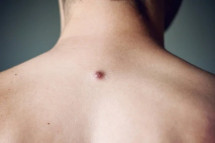 Dermatofibroma Removal: Skin Bump Diagnosis and Treatment